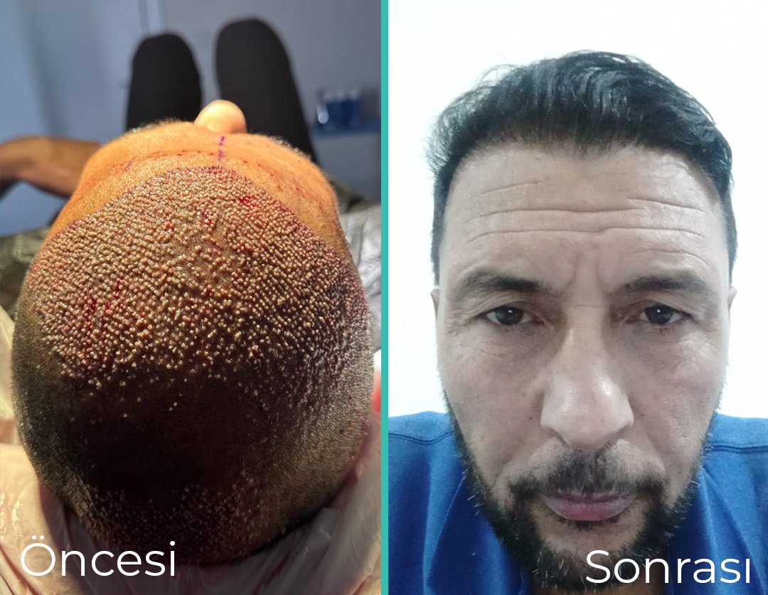 Carla Clinic hasta sonuç görseli — önce / sonra